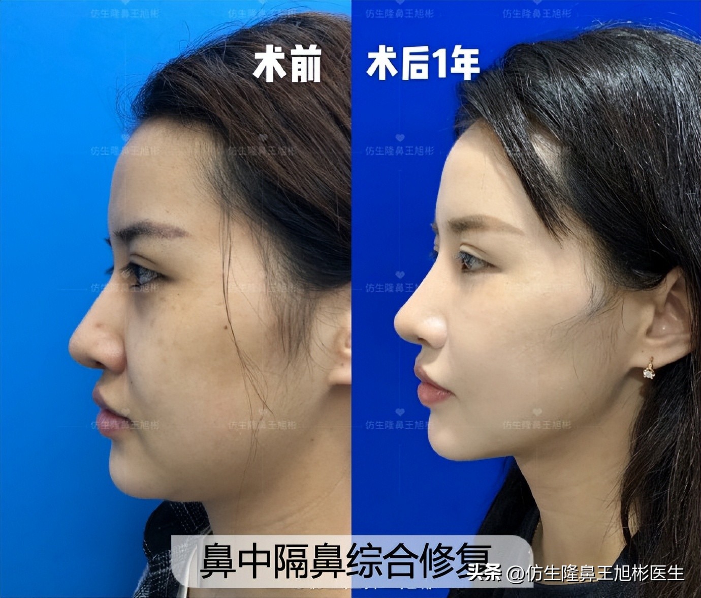 窄鼻子如何通过鼻整形来矫正,宽鼻子矫正方法