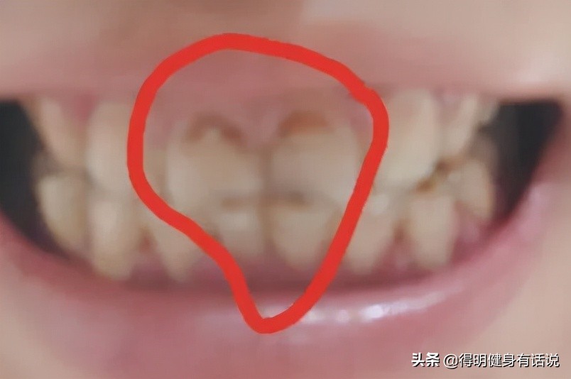 牙齿快暴露牙本质了怎么修复,牙齿已经露出牙本质了怎么修复