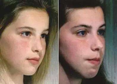 下巴短和后缩怎么变美,下巴后缩怎么矫正嘴尖