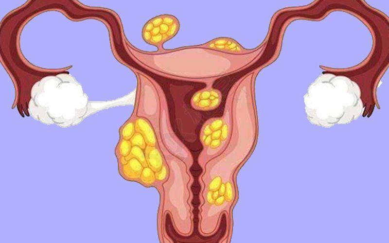 橘子治子宫肌瘤,桔子子宫肌瘤