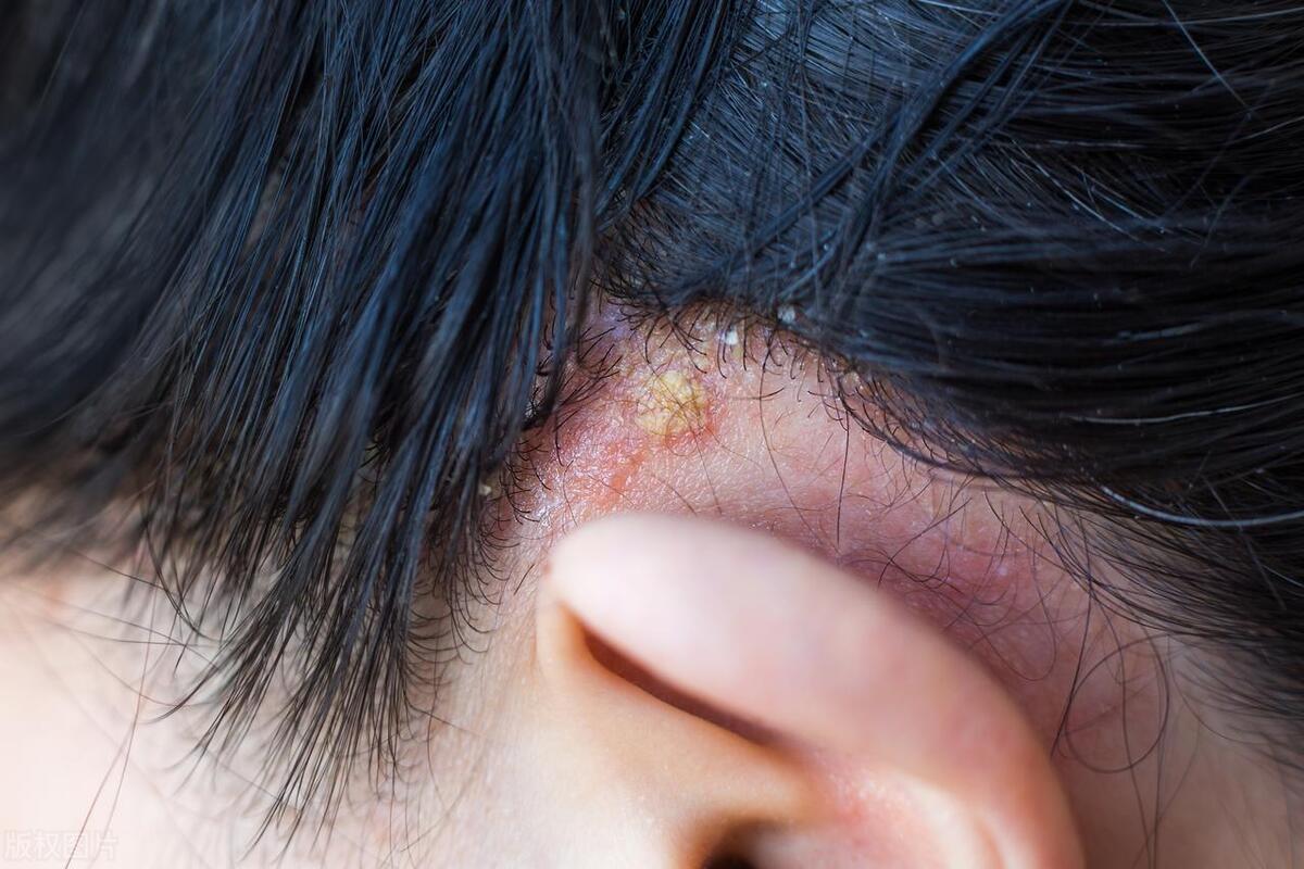 头皮经常长疙瘩什么原因,头皮总长疙瘩怎么回事手摸还疼