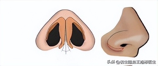 鼻尖整形最简单方法,鼻尖整形的方法图解