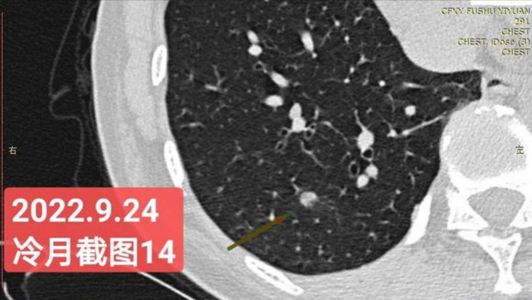 7mm肺结节恶性的怎么办,7mm实性肺结节危险程度