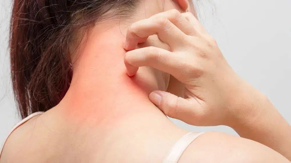 一到晚上就荨麻疹风团是什么原因,皮肤瘙痒荨麻疹的原因及治疗方法