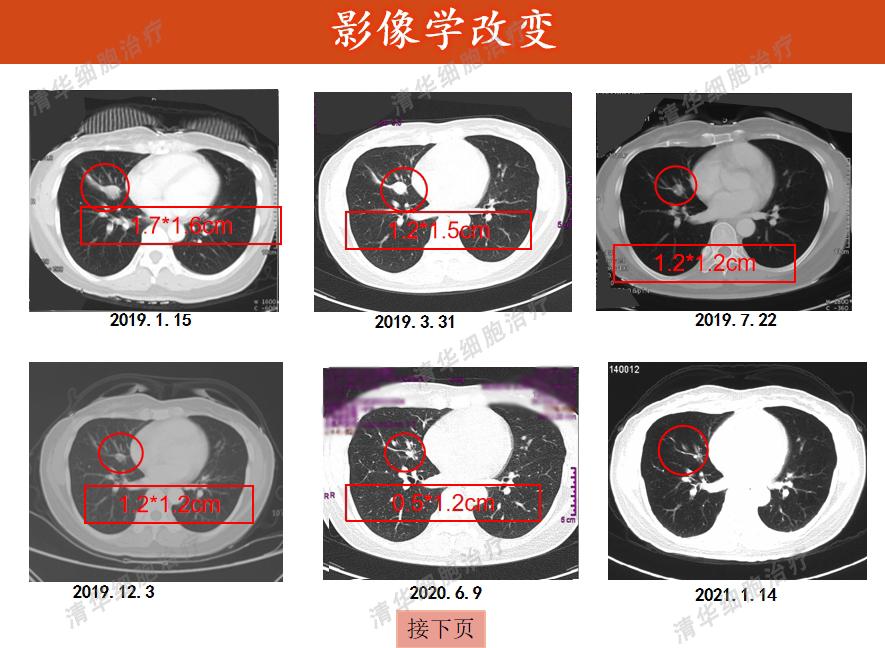 肉瘤领域的免疫疗法新策略,肉瘤免疫治疗的费用