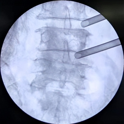 门医技术|门头沟区医院骨二科成功应用微创椎间孔镜技术治疗两例腰椎管多节段狭窄症