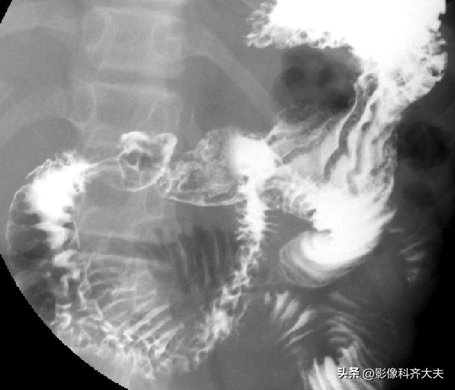 胃肠道造影超声解剖图,胃肠钡餐影像检查片子