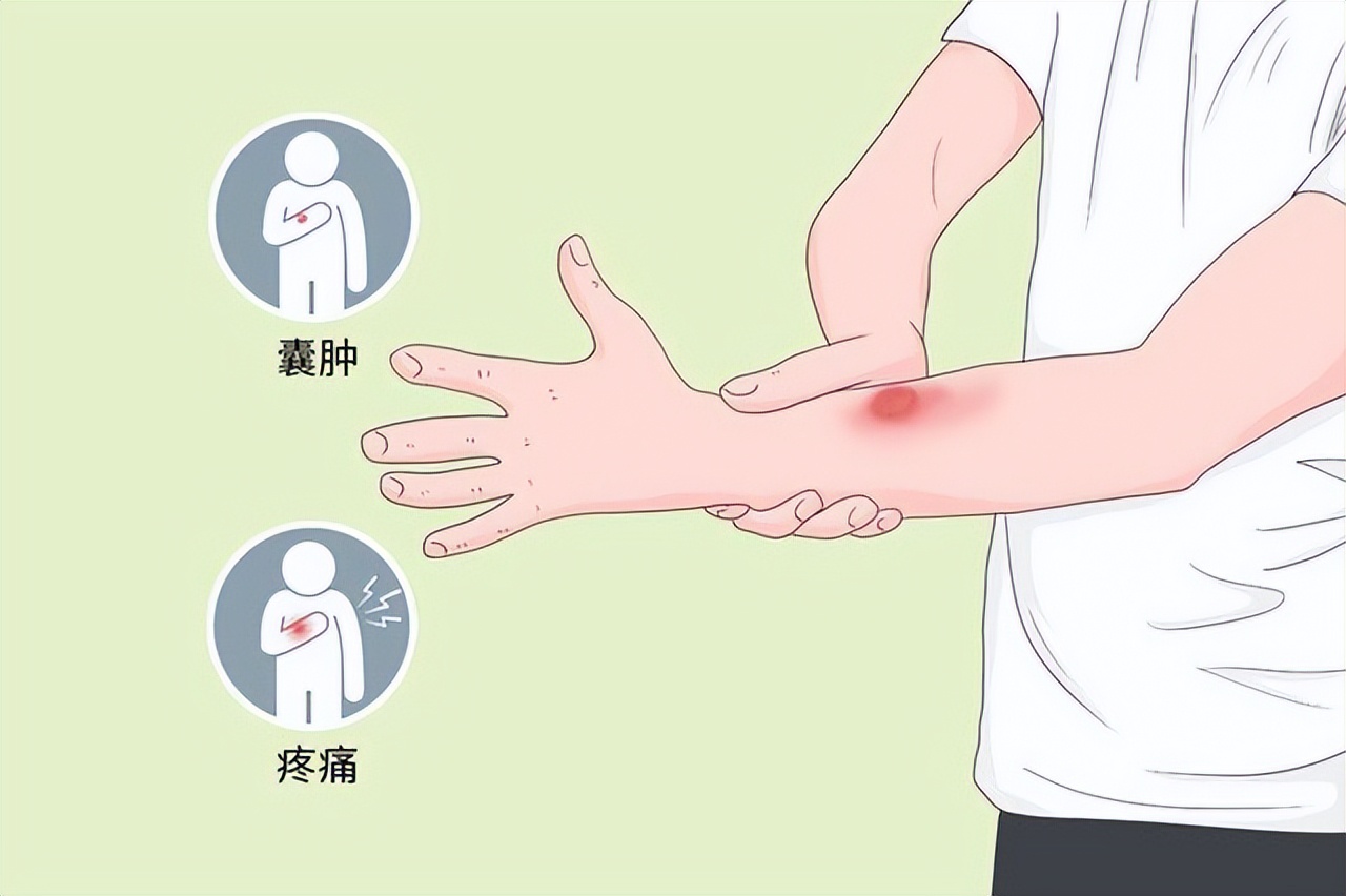 医生说囊肿是良性的但是需要手术,医生处理囊肿的视频