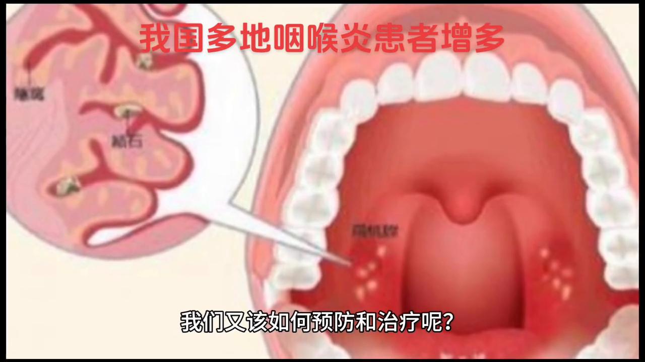 我国多地咽喉炎患者增多,我国多地咽喉炎患者增多吃什么药