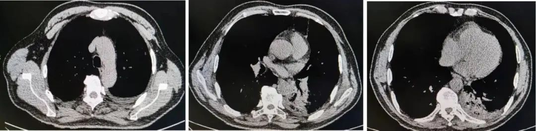 反复发烧但是拍片显示轻微肺炎,一直高烧39-40是肺炎么
