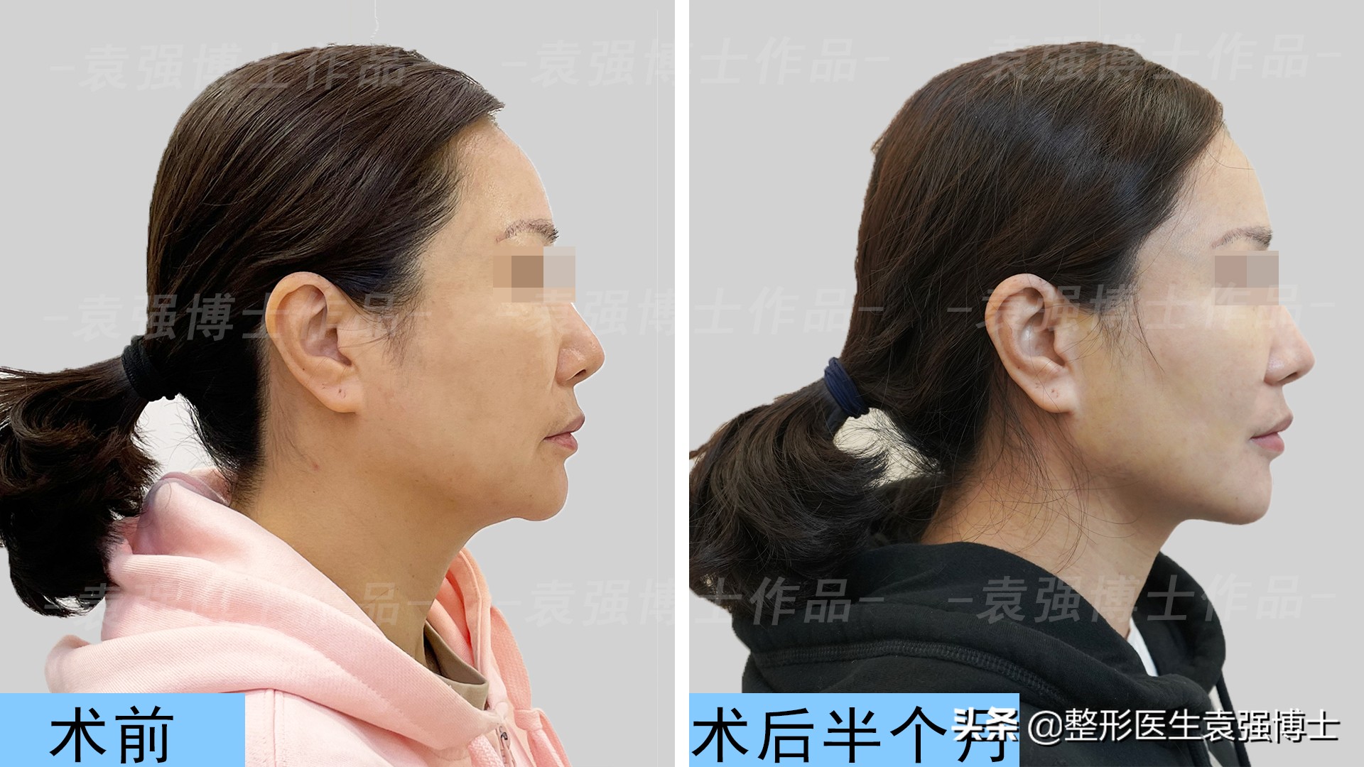 小拉皮能改善下颌线吗,拉皮手术改善下颌线