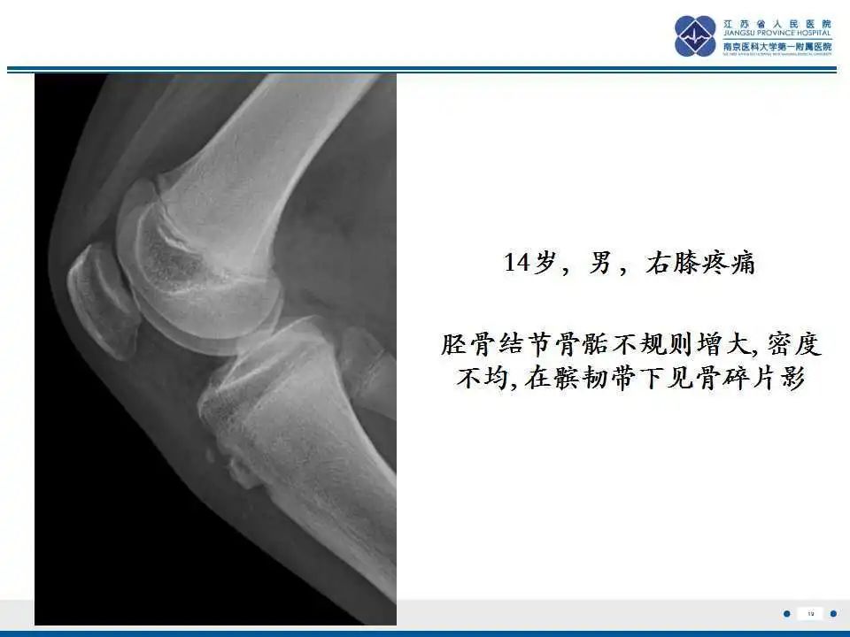 胫骨结节软骨炎要怎么治疗,胫骨结节骨软骨炎会癌变吗