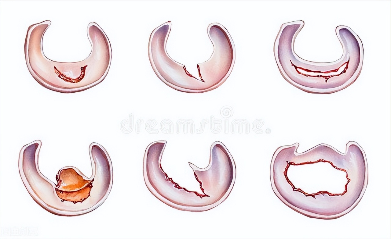 半月板撕裂三度自愈成功的案例,内侧半月板后角撕裂自愈要多久