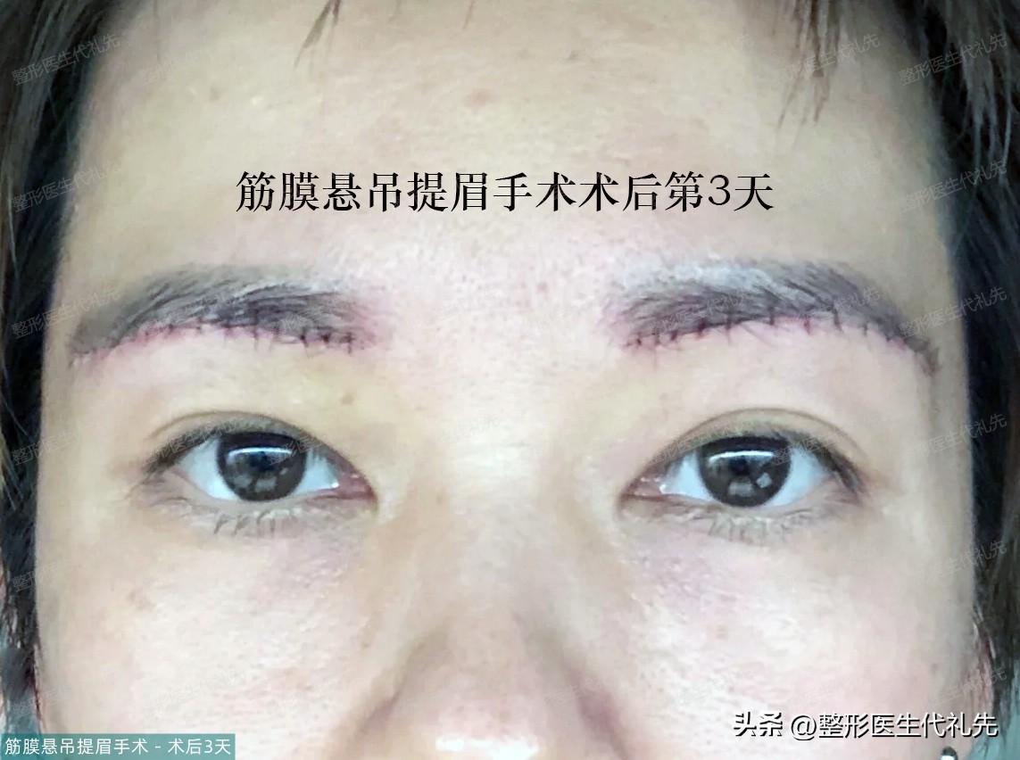 45岁女性做提眉手术多久能恢复,40岁做提眉手术的视频