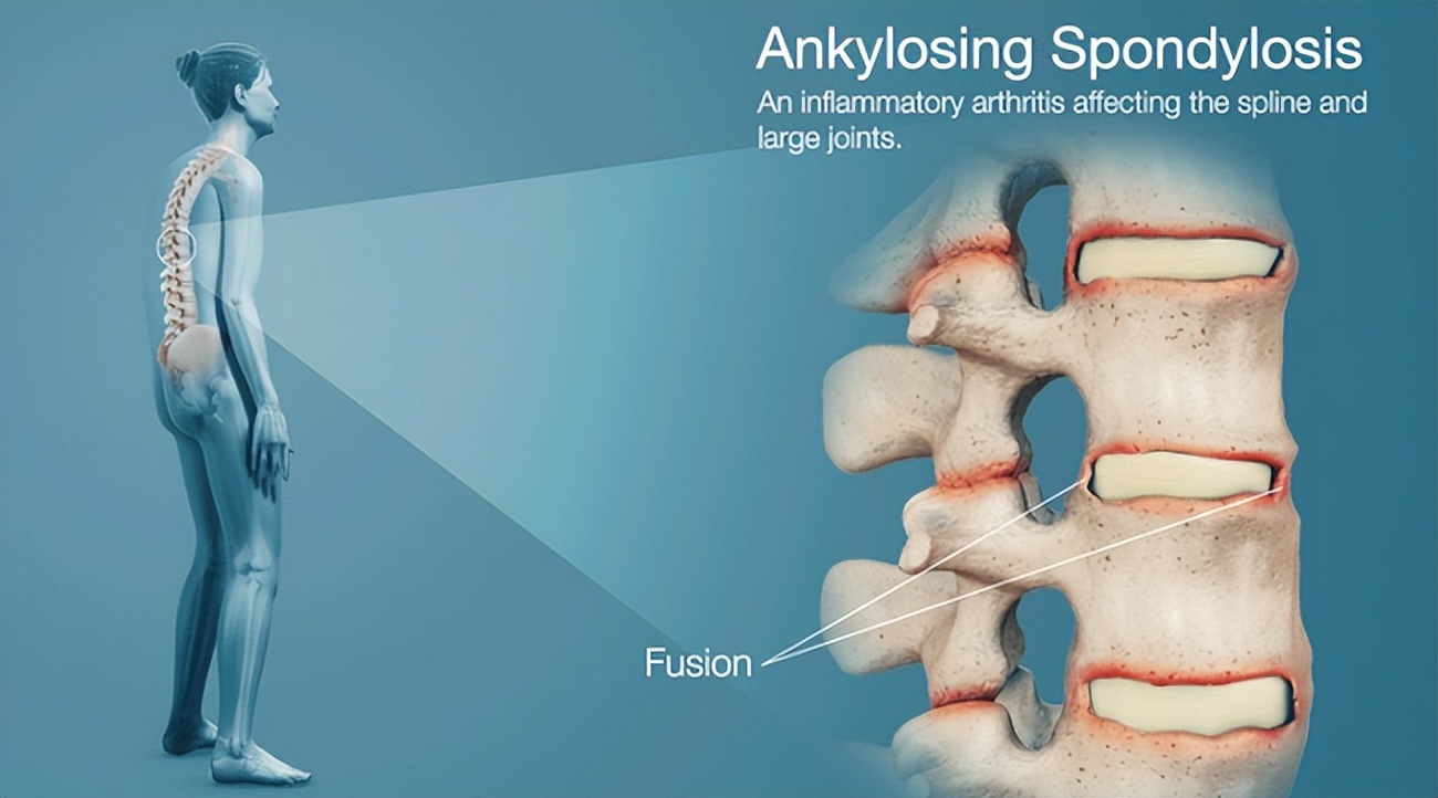 治疗强直性脊柱炎必须按体质治吗,针对强直性脊柱炎最好的锻炼方法