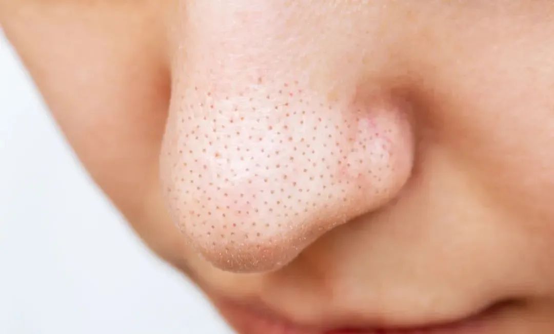 鼻子毛孔粗大黑头泛红怎么解决,鼻翼两侧有黑头还泛红如何护肤