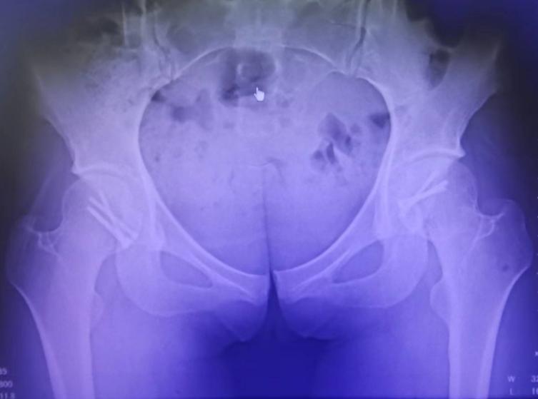 老人股骨头骨折手术,股骨头骨折最佳手术方法