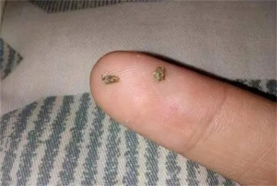 如何去除牙结石几个小妙招,去除牙结石最好的方法小妙招