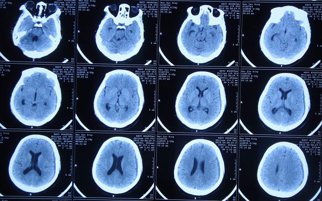 听神经瘤出现脑积水和出血,听神经瘤手术后颅压高症状
