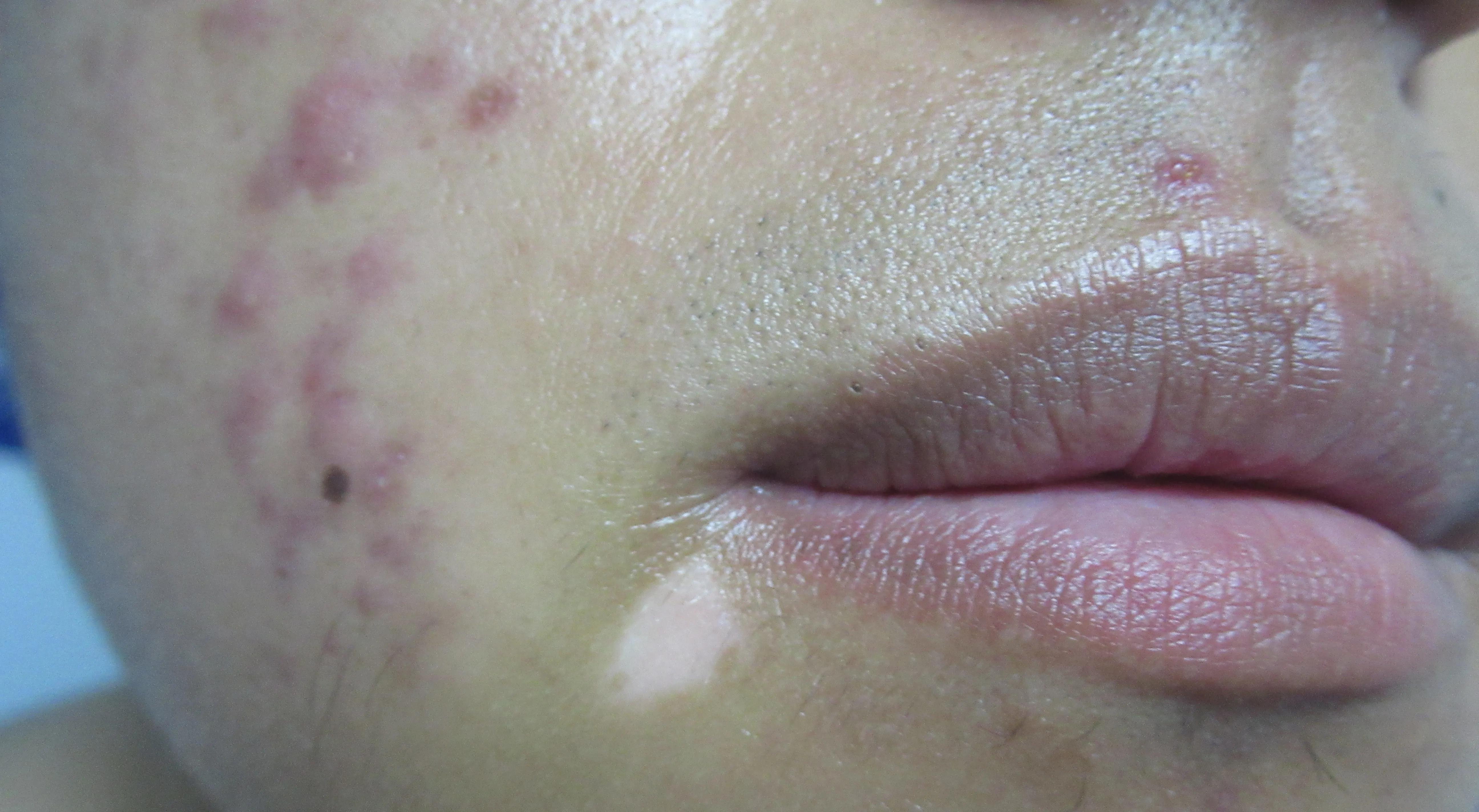 白癜风自愈的三大谣言,白癜风前期治疗是不是越来越明显