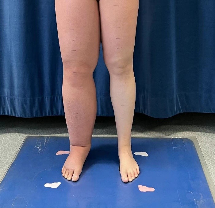 淋巴水肿犯丹毒了吃什么药,治疗丹毒水肿的绝招