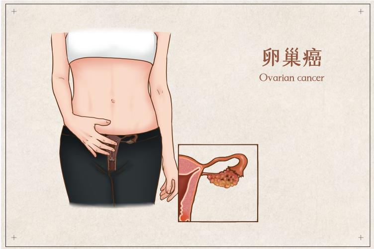 吉卡科普|组织驻留记忆T细胞调控卵巢癌症免疫反应