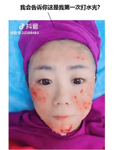 打水光针的痛苦,打水光针的惨痛经历