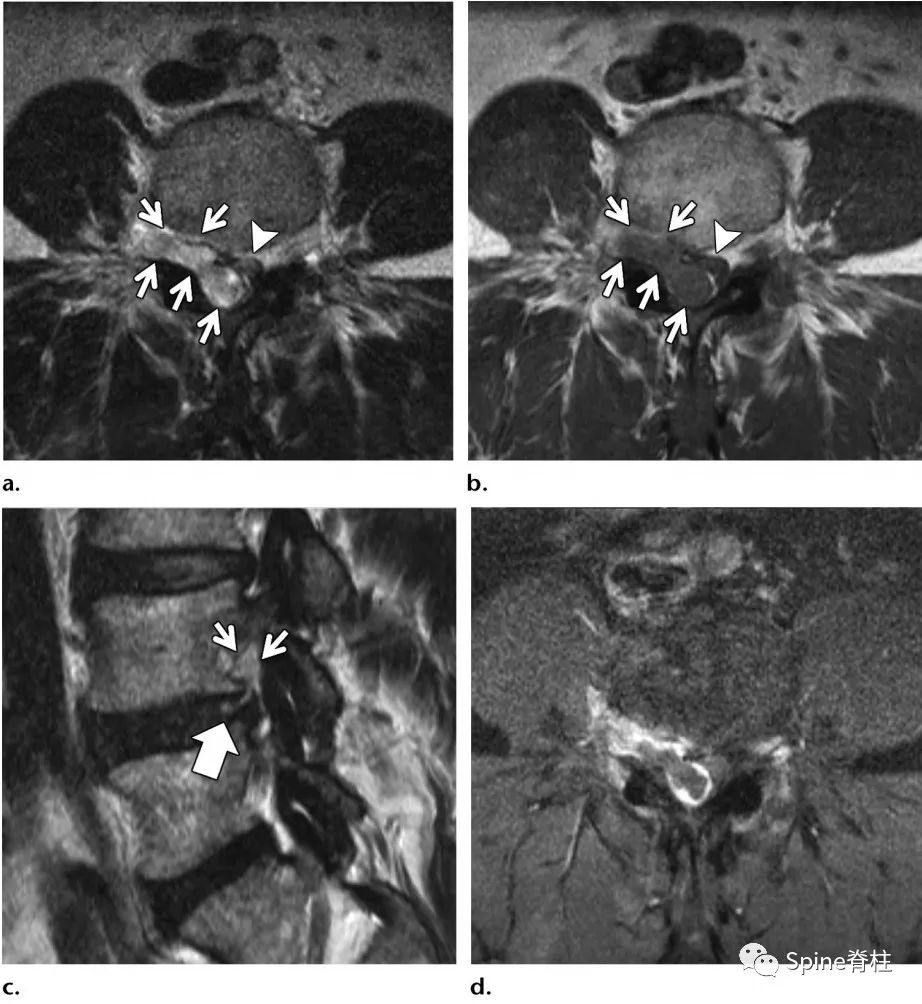 腰椎间盘突出症状表现,腰椎间盘突出症疼痛最佳止痛方法