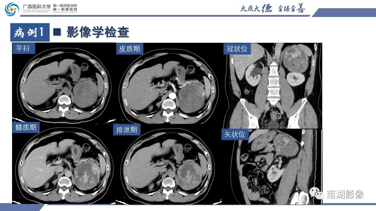 肾上腺海绵状血管瘤,肾上腺血管瘤是良性还是恶性