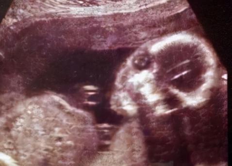 91岁老太怀孕离奇真相,老太意外怀孕60多年