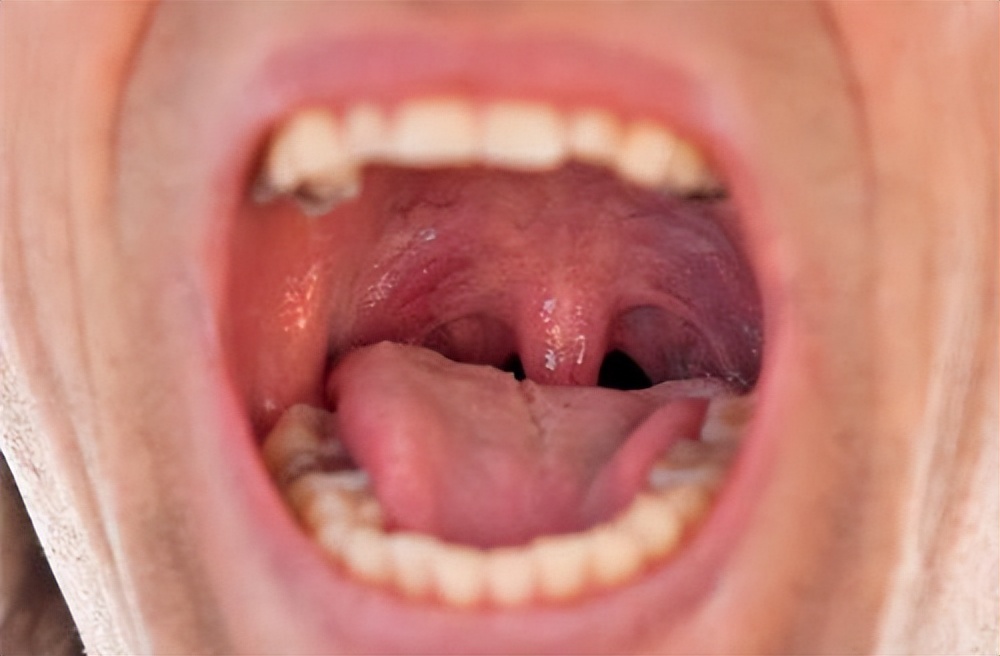 慢性咽炎咽干有异物感怎么治疗,咽喉炎咽干咽痛异物感怎么办