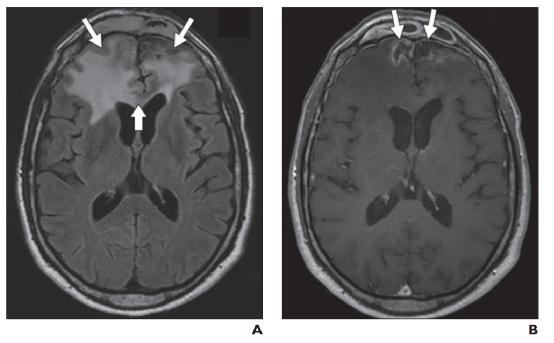 脑水肿的影像,脑水肿形成机制生理学