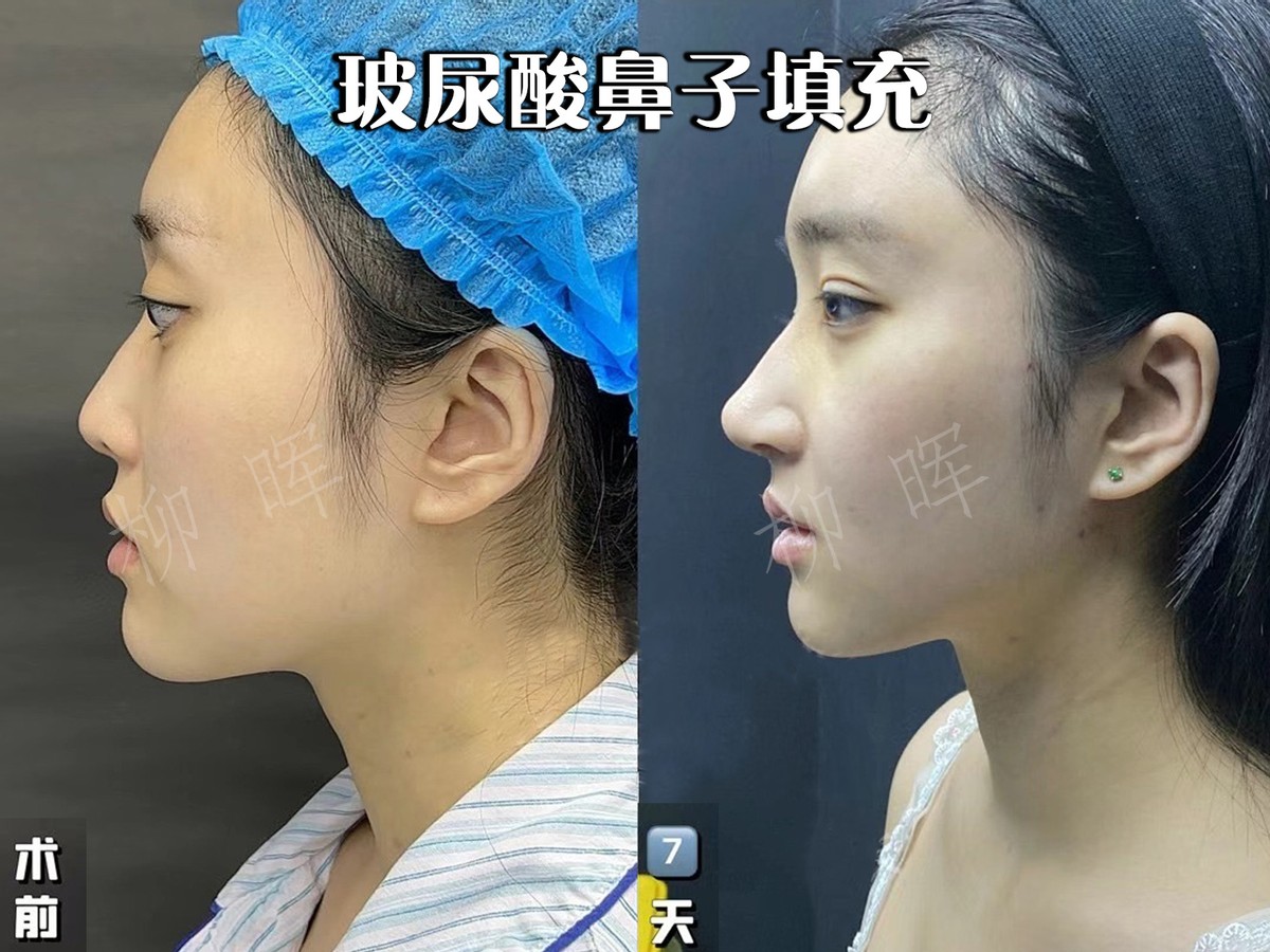 塌鼻子侧脸怎么变成高鼻梁p图,侧脸扁平没有立体感怎么拍照