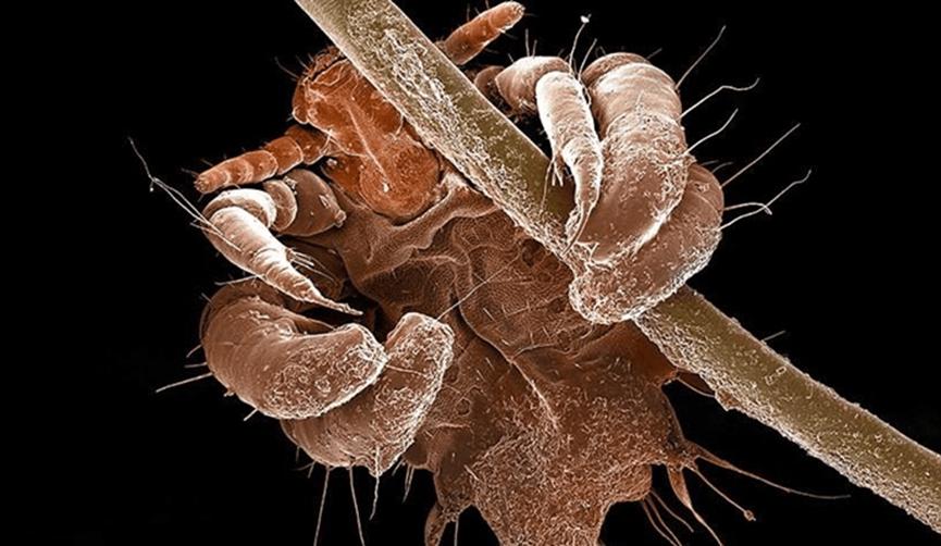 母女俩下腹瘙痒，医生用镊子夹出阴虱！原来阴虱有这4个传播途径