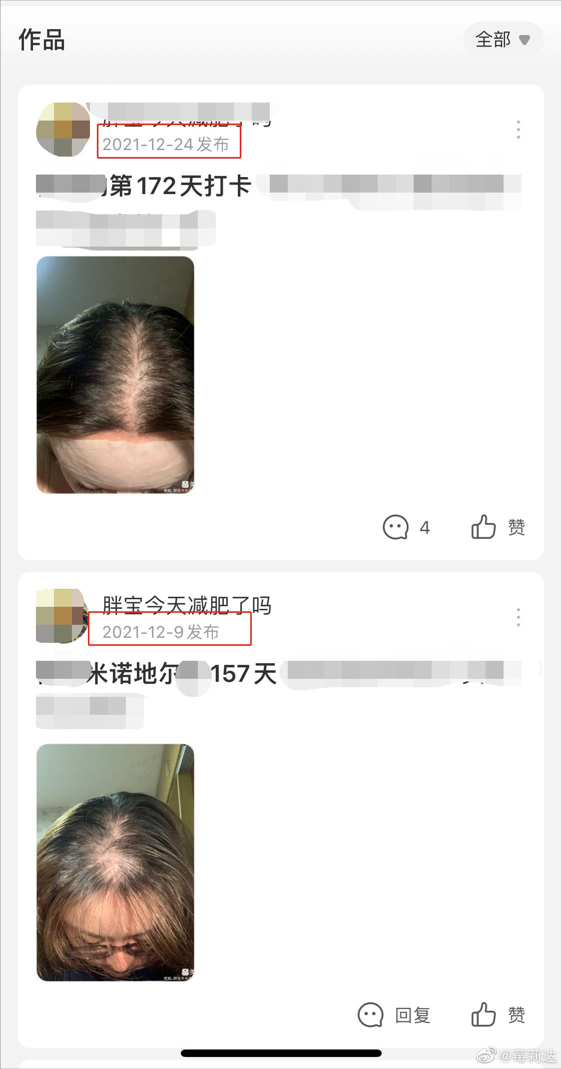 米诺地尔狂脱期前后对比,亲身经历米诺地尔的狂脱期