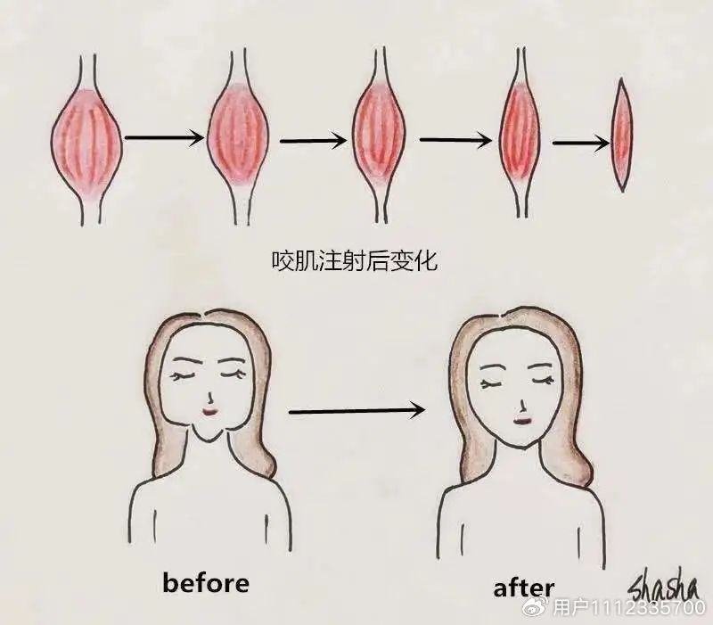 肉毒素注射后的注意事项有哪些,涂抹肉毒素和注射肉毒素