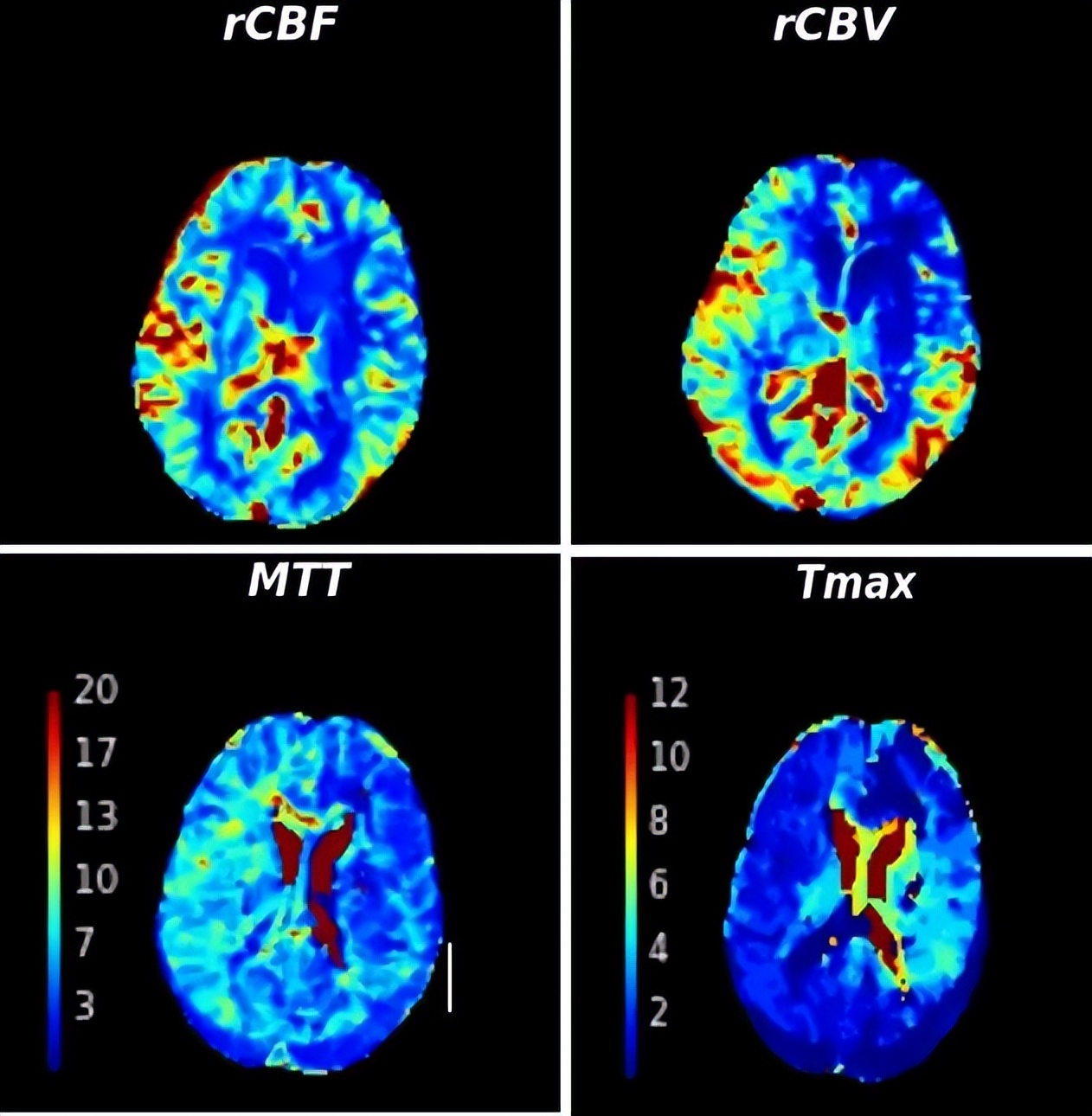 首创国内ICAS多模态评估体系开创脑血管领域精准诊疗新纪元