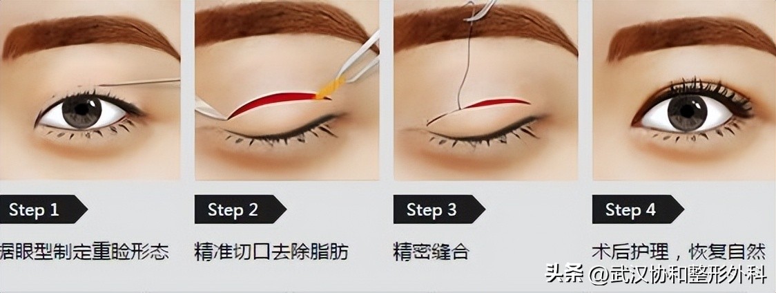 平行双眼皮手术图片,埋线双眼皮手术价格