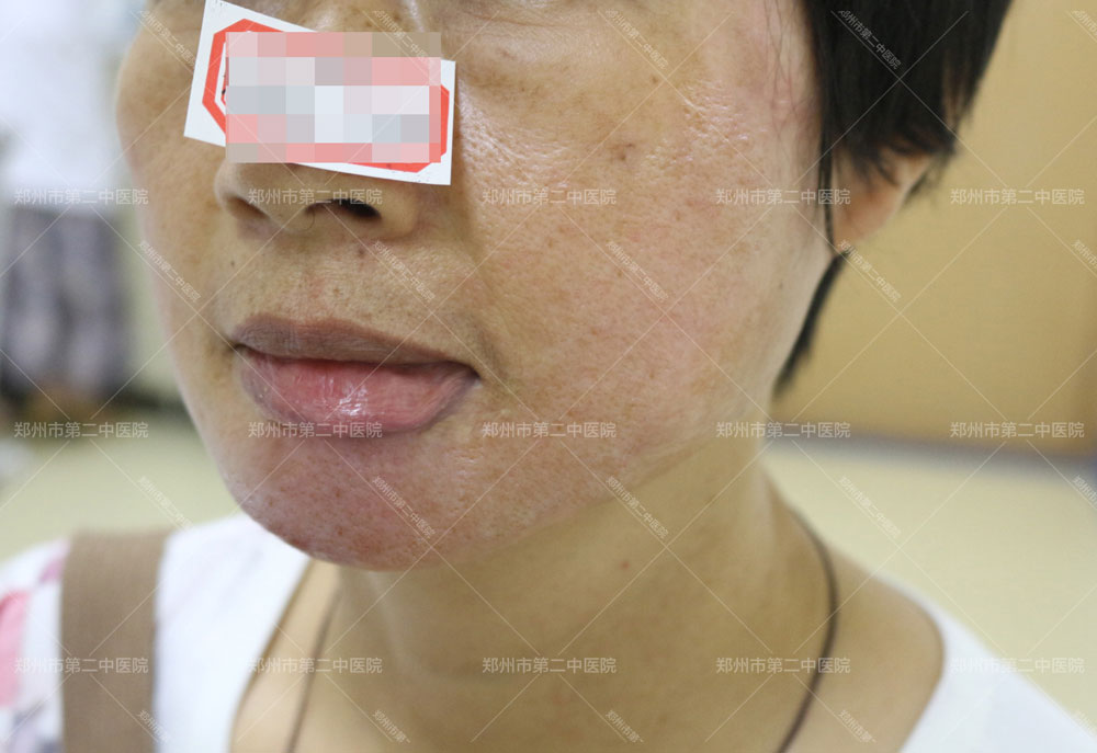 郑州提供疤痕修复多少钱,郑州市哪里修复疤痕最好