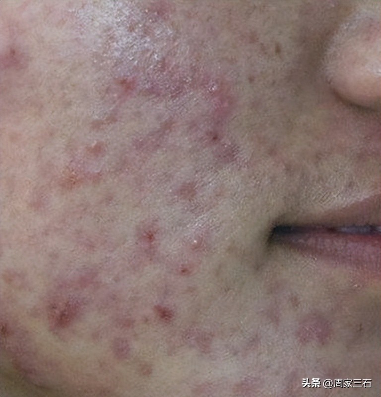 疮毒治疗中成药,治疗疮疡的用药