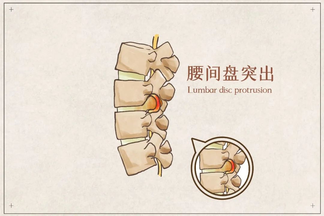 腰椎间盘突出怎样让它缩小,腰椎间盘突出最快缓解方法学生