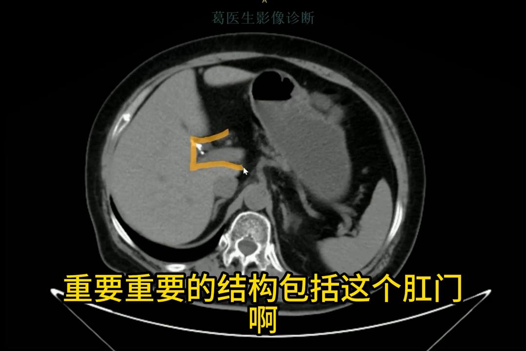 腹部ct影像解剖图谱,腹部ct阑尾影像