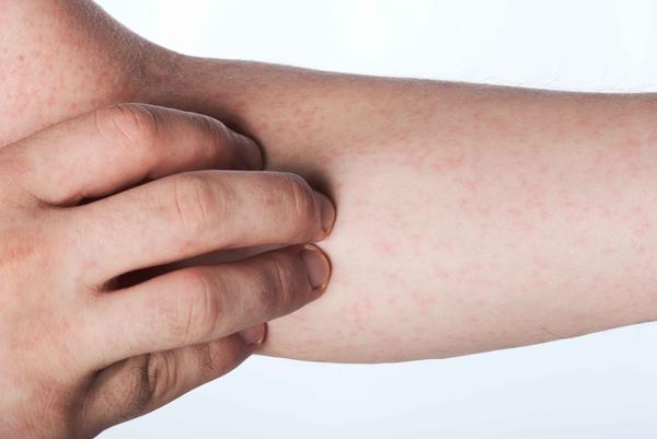 身上长小红点一到晚上就严重,身上长小红点不痛不痒是啥病