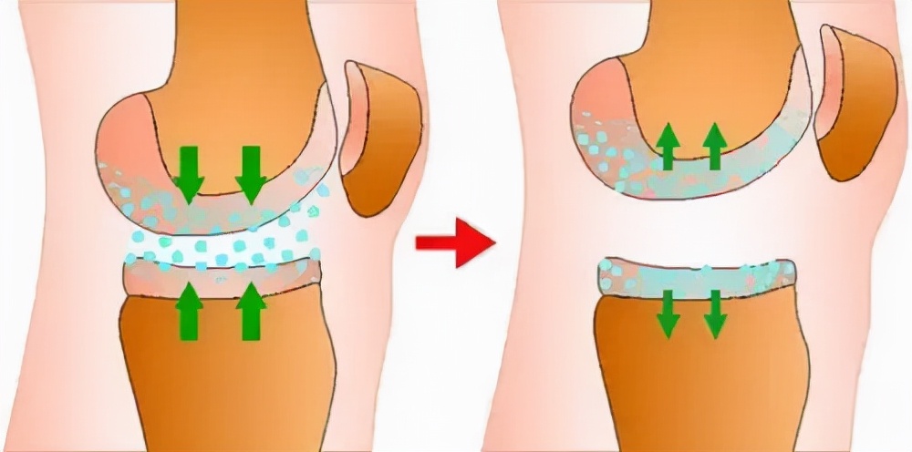 膝关节炎打玻璃酸钠几针见效,膝关节炎打玻璃酸钠好还是去针灸