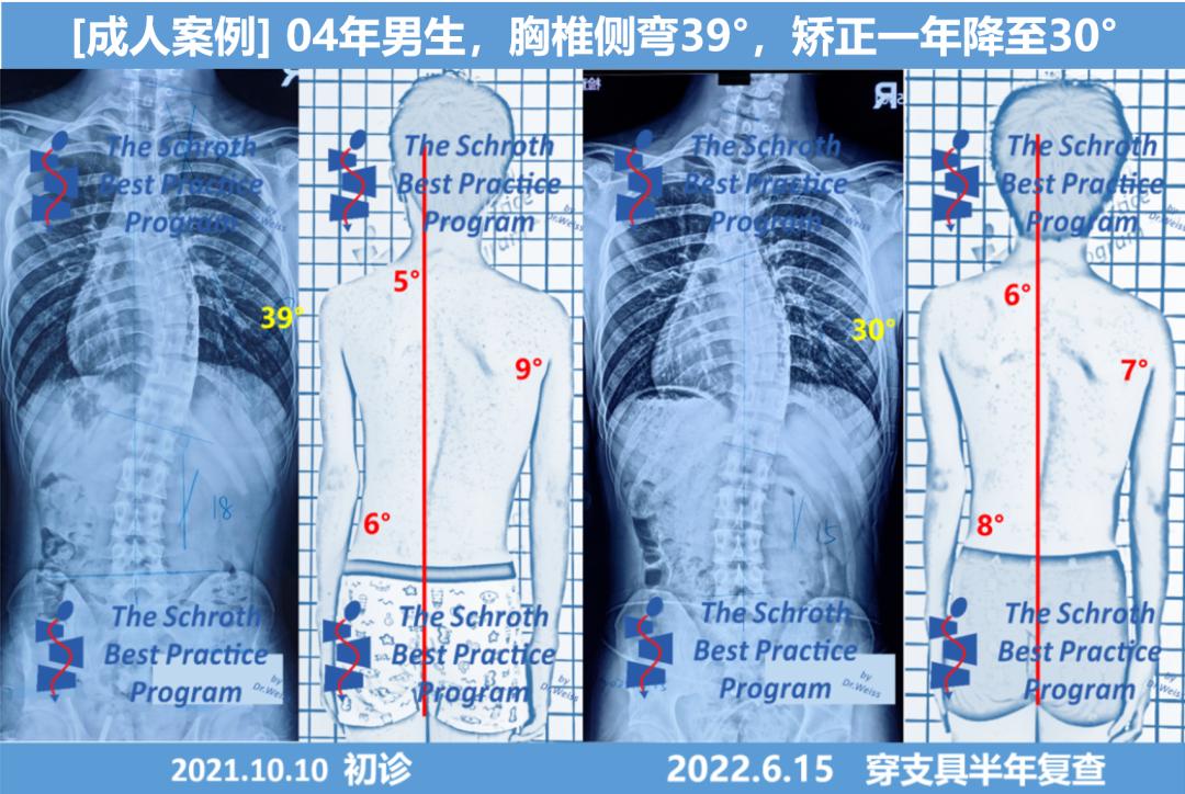 成人脊柱侧弯往哪弯,成年人脊柱侧弯怎么矫正