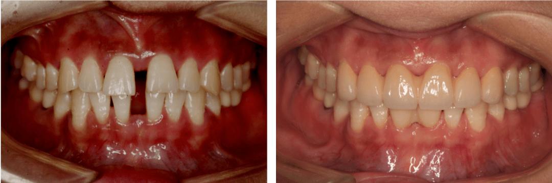 牙缝没清理干净会把牙缝变大吗,牙缝卡了东西导致牙缝变大怎么办
