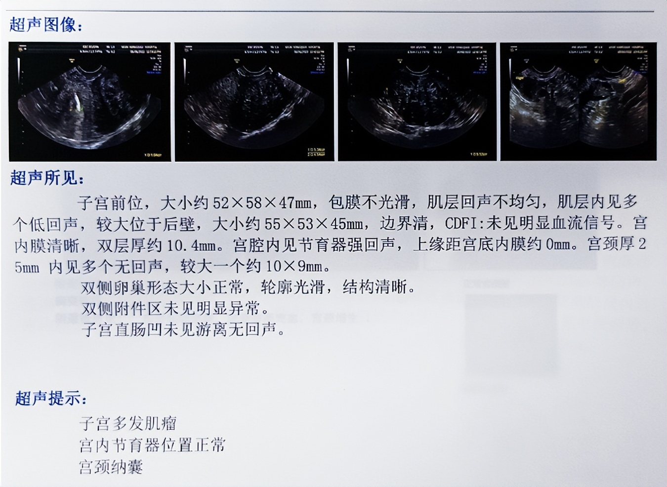 4年,她的子宫肌瘤长大了一倍