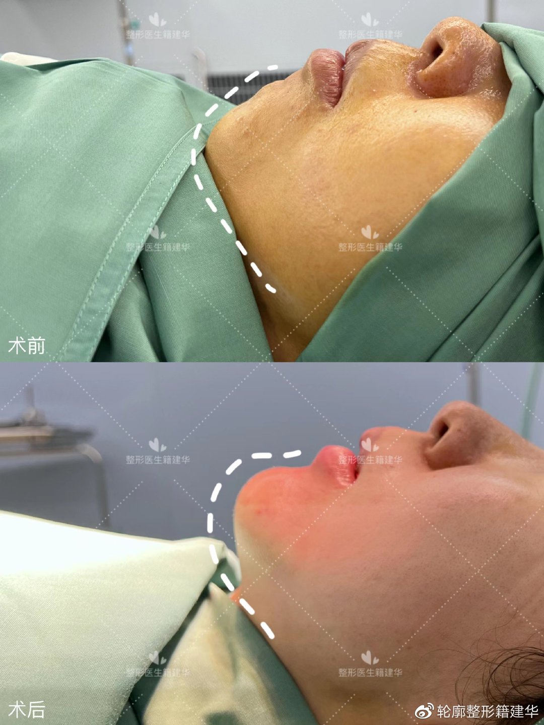 下巴后缩要怎么整形,下巴后缩做什么手术矫正