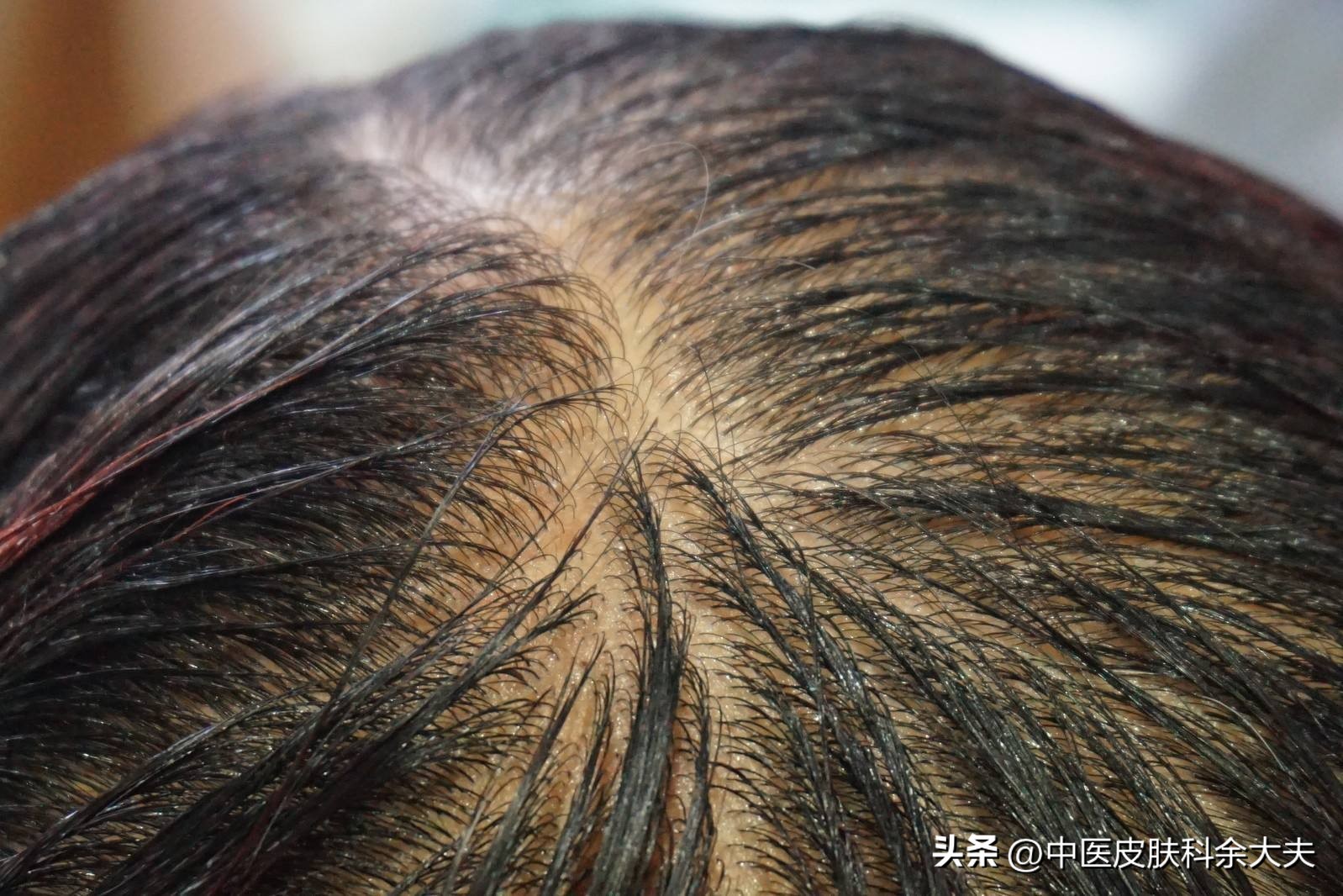 脱发是气血不好的表现吗,脱发说是内分泌失调什么意思