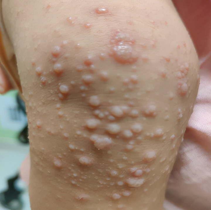 宝宝健康学堂全集,宝宝病毒感染嘴巴手脚里面长疱疹